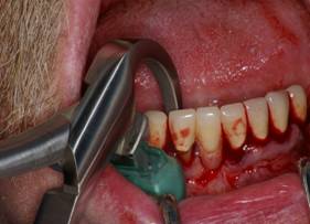 Dental Implants Procedure