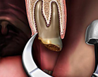 Dental Extraction Forceps - Step 2