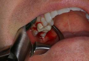 Tooth Extraction