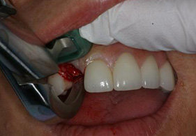 Dental Implants Procedure