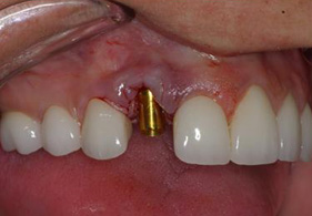 Dental Implants Procedure