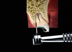 Wisdom Tooth Extraction