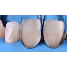 Polydentia Unica Anterior Matrix Intro Kit