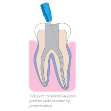Endo Irrigation Needles Single Side Vent