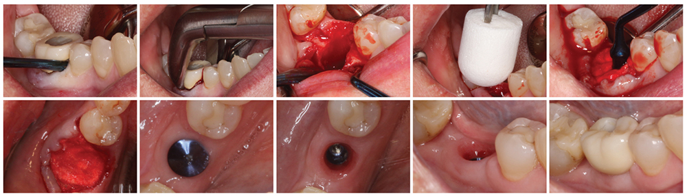 ideal implant esthetics in his practice for his patients. 